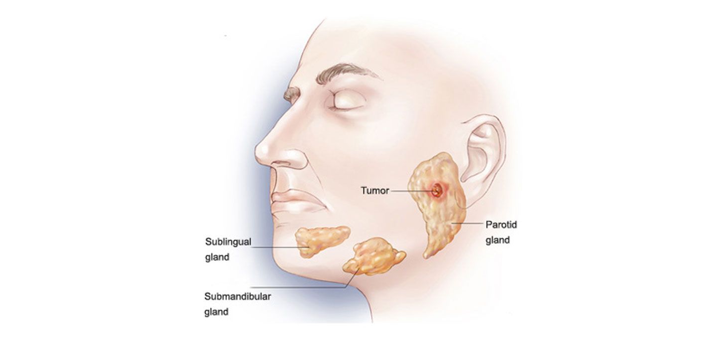 Parotid Surgery