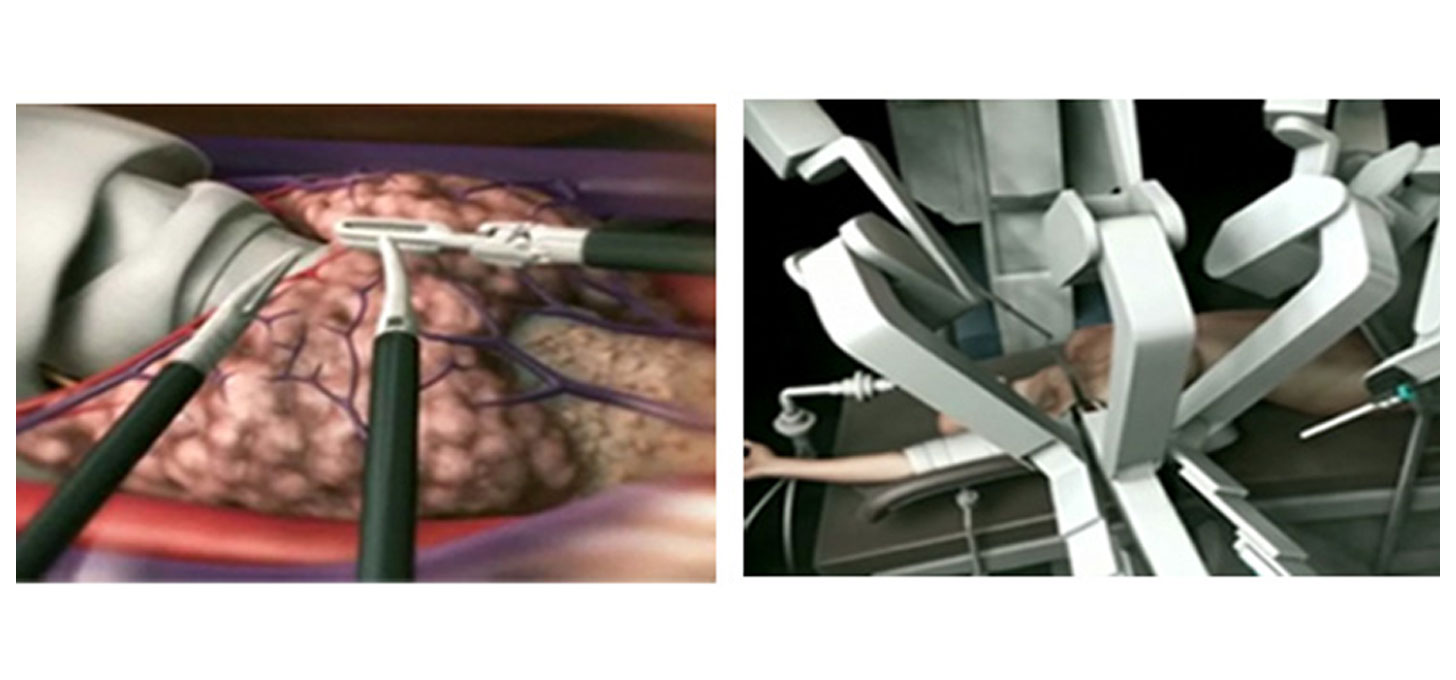 Robotic Surgery